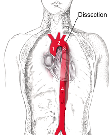 赤い血管が大動脈です。