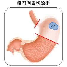 胃の口側（上側）を切除して、食道と肛門側（下側）の胃とつなぎます。