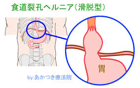 食道裂孔ヘルニアは、横隔膜から上にとび出た胃のことです。